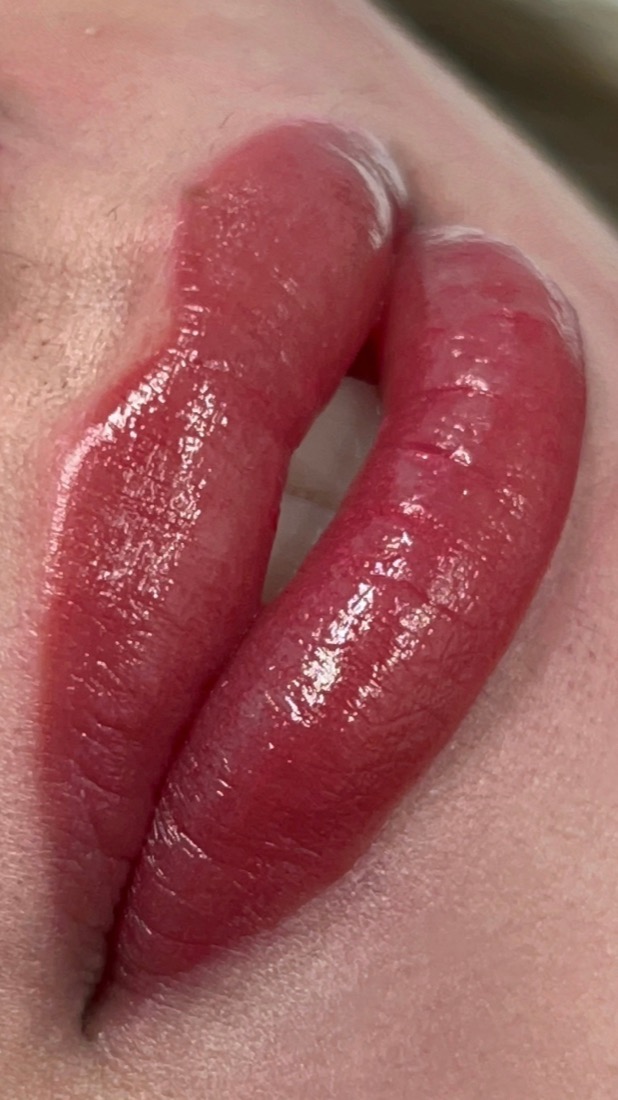 Resultado de Micro labial